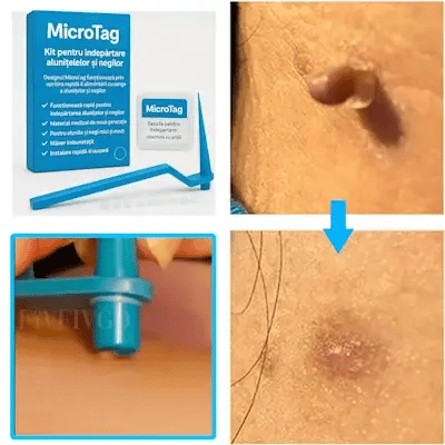 Kit Îndepărtare Negi și Alunițe - MicroTag